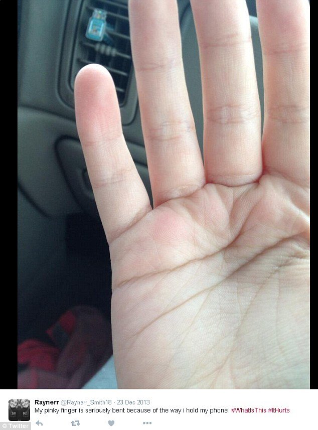 Ποστάρουν φωτογραφίες με τα παραμορφωμένα τους δάχτυλα -Από την ατελείωτη χρήση smart phones [εικόνες] | iefimerida.gr 4