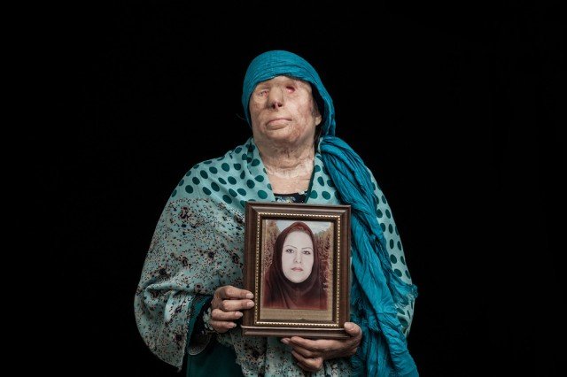 Γυναίκες στο Ιράν που επέζησαν από επιθέσεις με οξύ -Συγκλονιστικές ιστορίες, σοκαριστικές εικόνες | iefimerida.gr 1
