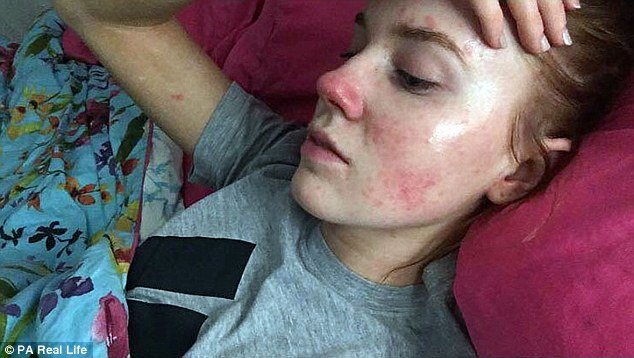 Ζώντας με ψωρίαση -Μια κοπέλα μίσησε και αγάπησε τα κόκκινα σημάδια της [εικόνες] | iefimerida.gr 1