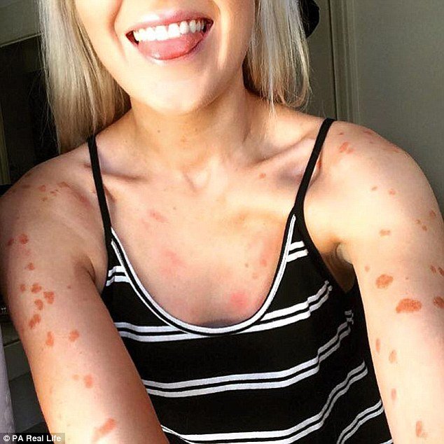 Ζώντας με ψωρίαση -Μια κοπέλα μίσησε και αγάπησε τα κόκκινα σημάδια της [εικόνες] | iefimerida.gr 2