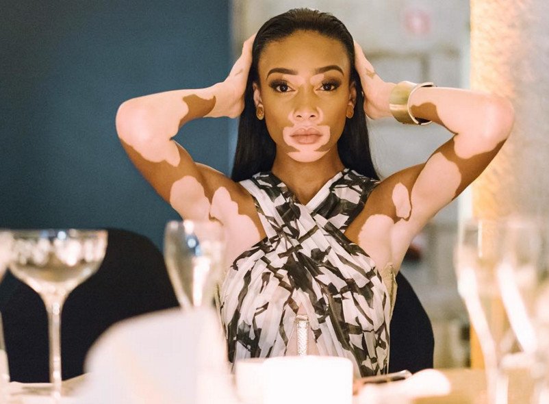 Το μοντέλο με τη λεύκη που «σβήνει» όλα τα τοπ μόντελ [εικόνες] | iefimerida.gr 22