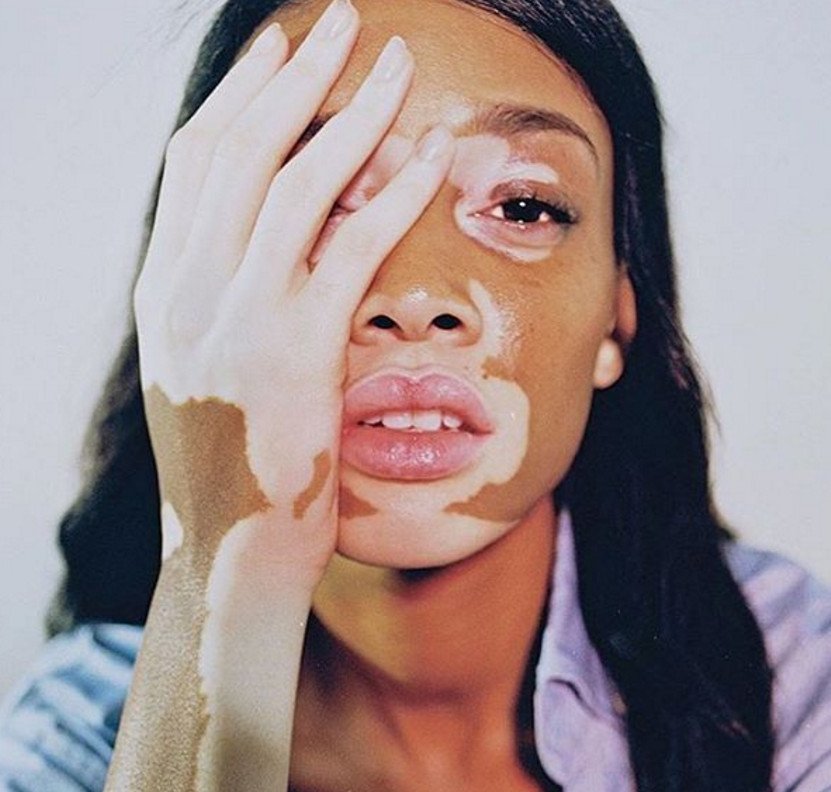 Το μοντέλο με τη λεύκη που «σβήνει» όλα τα τοπ μόντελ [εικόνες] | iefimerida.gr 21