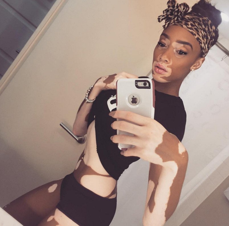 Το μοντέλο με τη λεύκη που «σβήνει» όλα τα τοπ μόντελ [εικόνες] | iefimerida.gr 29