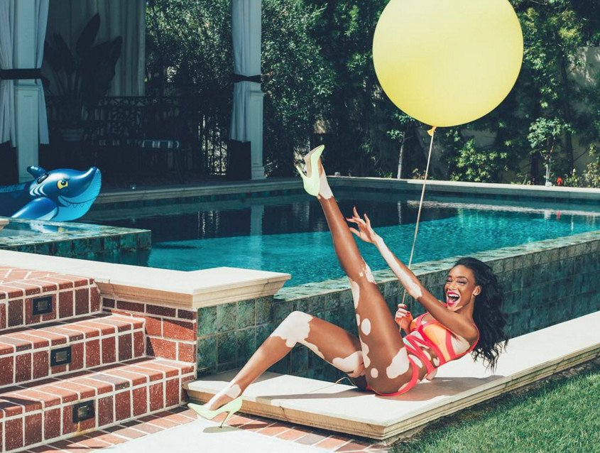 Το μοντέλο με τη λεύκη που «σβήνει» όλα τα τοπ μόντελ [εικόνες] | iefimerida.gr 28