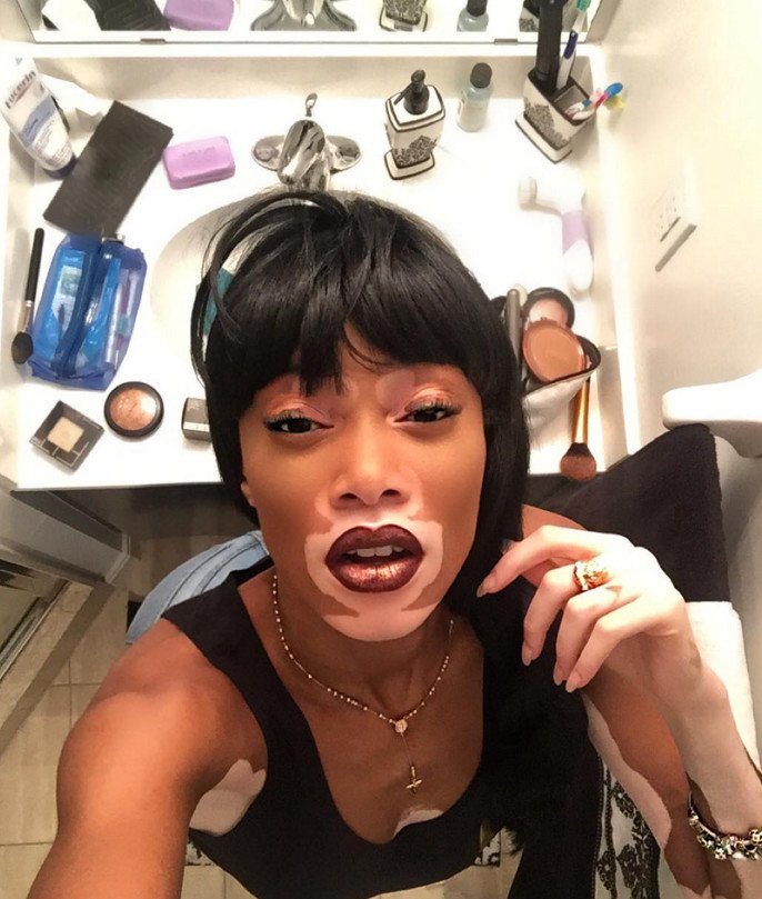 Το μοντέλο με τη λεύκη που «σβήνει» όλα τα τοπ μόντελ [εικόνες] | iefimerida.gr 24