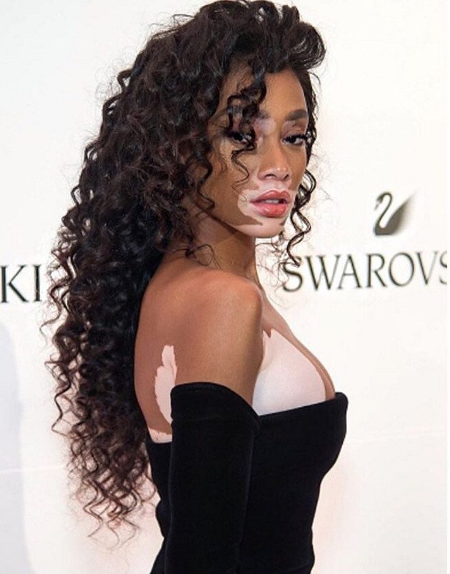 Το μοντέλο με τη λεύκη που «σβήνει» όλα τα τοπ μόντελ [εικόνες] | iefimerida.gr 0