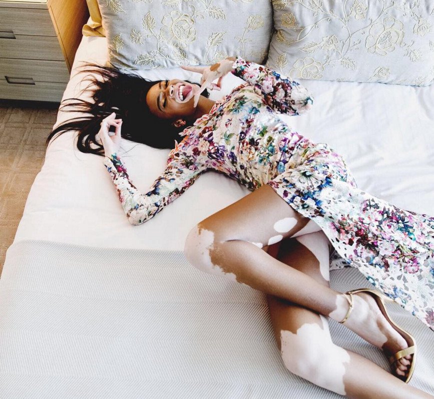 Το μοντέλο με τη λεύκη που «σβήνει» όλα τα τοπ μόντελ [εικόνες] | iefimerida.gr 14