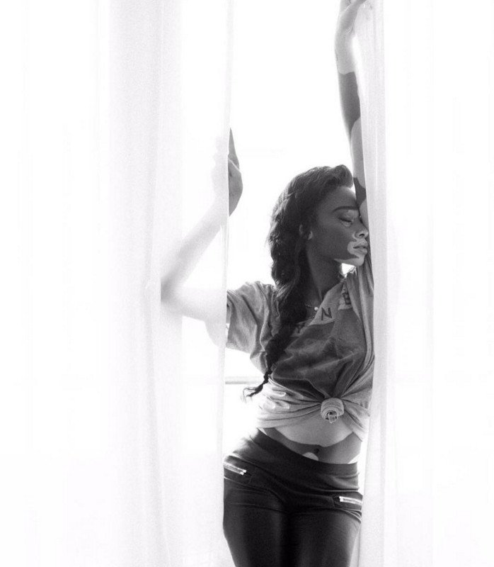 Το μοντέλο με τη λεύκη που «σβήνει» όλα τα τοπ μόντελ [εικόνες] | iefimerida.gr 16