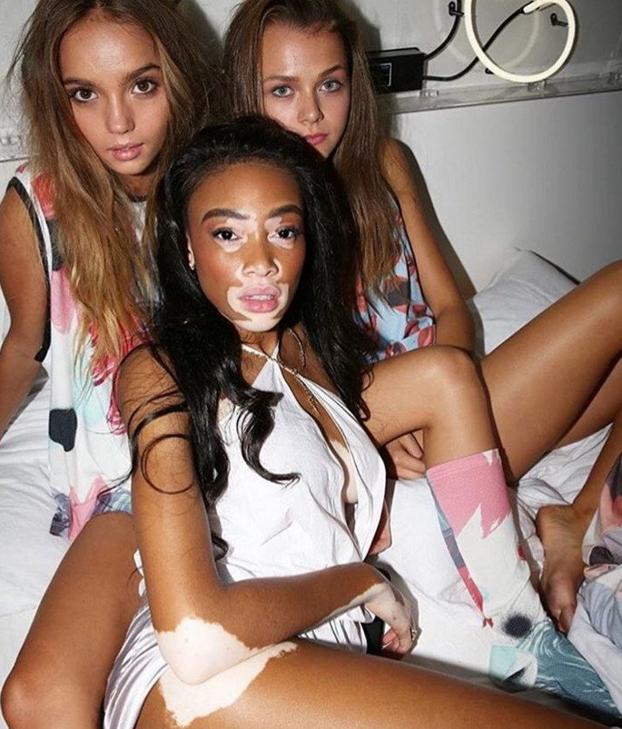 Το μοντέλο με τη λεύκη που «σβήνει» όλα τα τοπ μόντελ [εικόνες] | iefimerida.gr 18