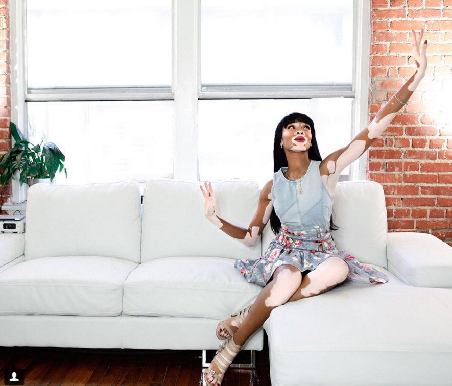 Το μοντέλο με τη λεύκη που «σβήνει» όλα τα τοπ μόντελ [εικόνες] | iefimerida.gr 13