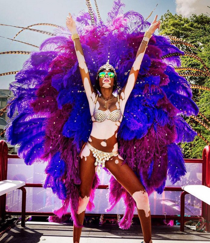 Το μοντέλο με τη λεύκη που «σβήνει» όλα τα τοπ μόντελ [εικόνες] | iefimerida.gr 5