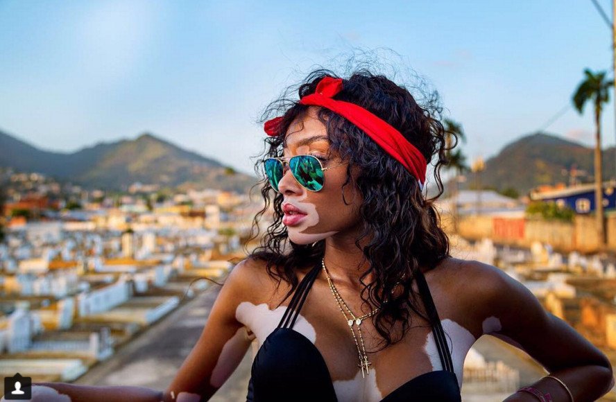 Το μοντέλο με τη λεύκη που «σβήνει» όλα τα τοπ μόντελ [εικόνες] | iefimerida.gr 6