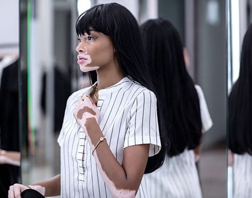 Το μοντέλο με τη λεύκη που «σβήνει» όλα τα τοπ μόντελ [εικόνες] | iefimerida.gr 10