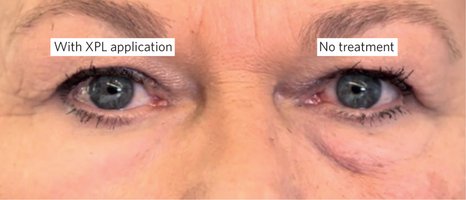 Το νέο lifting των 24 ωρών: Εξαφανίζει τις ρυτίδες [εικόνες] | iefimerida.gr 1