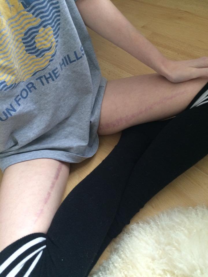 19χρονη φωτογραφίζεται με τη νόσο του Κρον και συγκλονίζει το Ιντερνετ [εικόνες] | iefimerida.gr 1