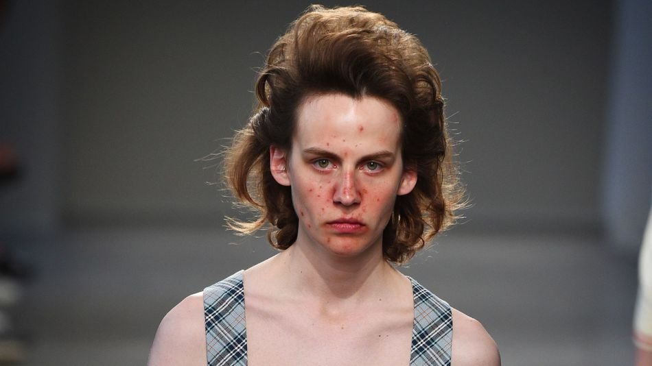 Μοντέλα με ακμή σε πασαρέλες του Μιλάνο [εικόνες] | iefimerida.gr 0