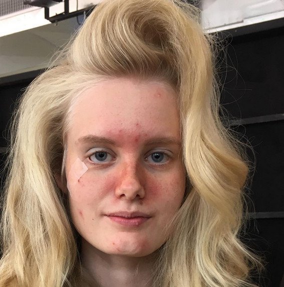 Μοντέλα με ακμή σε πασαρέλες του Μιλάνο [εικόνες] | iefimerida.gr 2