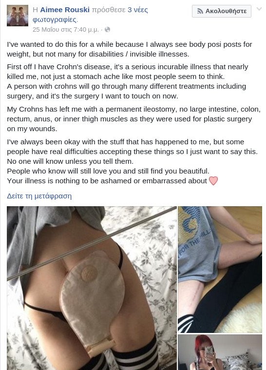 19χρονη φωτογραφίζεται με τη νόσο του Κρον και συγκλονίζει το Ιντερνετ [εικόνες] | iefimerida.gr 3
