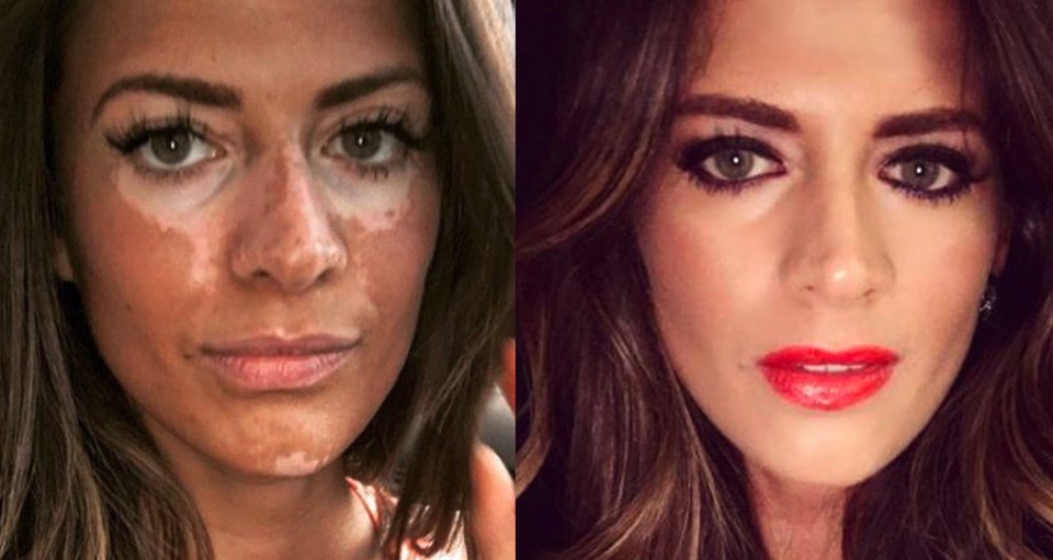 Τι είναι ομορφιά; Μια γυναίκα με λεύκη, εξηγεί [εικόνες] | iefimerida.gr 0