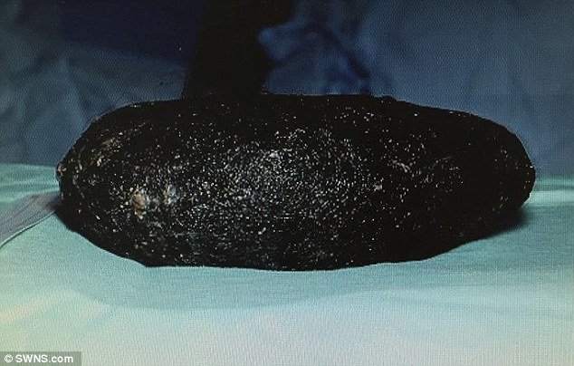 Απίστευτο: Αφαίρεσαν τριχόμπαλα 6 κιλών και 30 εκατοστών από στομάχι 23χρονης [εικόνες] | iefimerida.gr 3