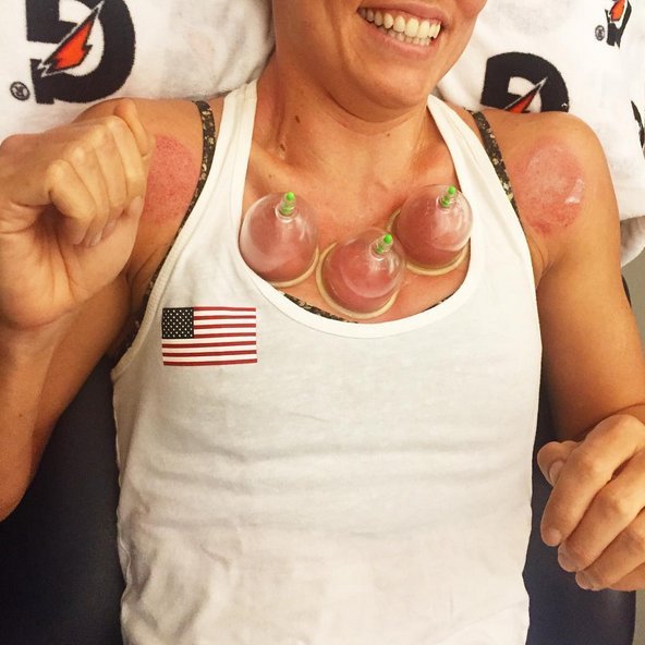 Γιατί οι αθλητές στο Ρίο είναι γεμάτοι μελανές βούλες [εικόνες] | iefimerida.gr 4