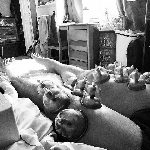 Γιατί οι αθλητές στο Ρίο είναι γεμάτοι μελανές βούλες [εικόνες] | iefimerida.gr 5