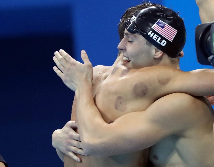 Γιατί οι αθλητές στο Ρίο είναι γεμάτοι μελανές βούλες [εικόνες] | iefimerida.gr 1