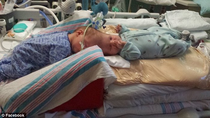 Κατάφεραν να χωρίσουν σιαμαία ενωμένα στο κεφάλι [εικόνες]  | iefimerida.gr 0