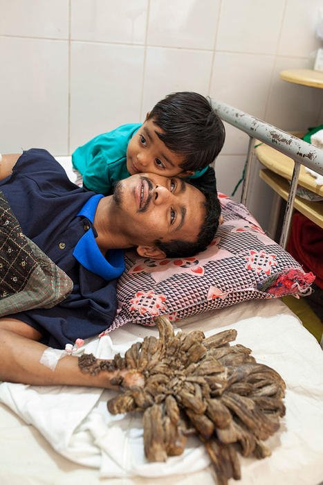 Γιατρεύτηκε ο «άνθρωπος-δέντρο» από το Μπαγκλαντές- Μετά από 16 επεμβάσεις [εικόνες & βίντεο] | iefimerida.gr 0