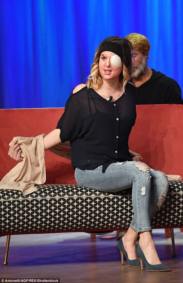 Σοκάρει η Ιταλίδα καλλονή: Μου έριξε οξύ στο πρόσωπο ο σύντροφός μου [εικόνες & βίντεο] | iefimerida.gr 1