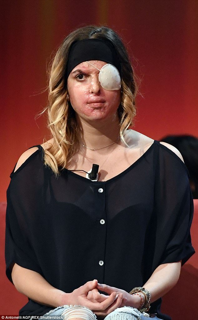 Σοκάρει η Ιταλίδα καλλονή: Μου έριξε οξύ στο πρόσωπο ο σύντροφός μου [εικόνες & βίντεο] | iefimerida.gr 2