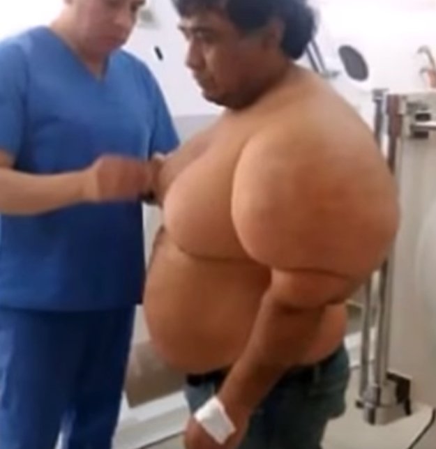 Απίστευτη παραμόρφωση: Ψαράς έπαθε τη νόσο του δύτη και φούσκωσε σαν μπαλόνι [βίντεο] | iefimerida.gr 3