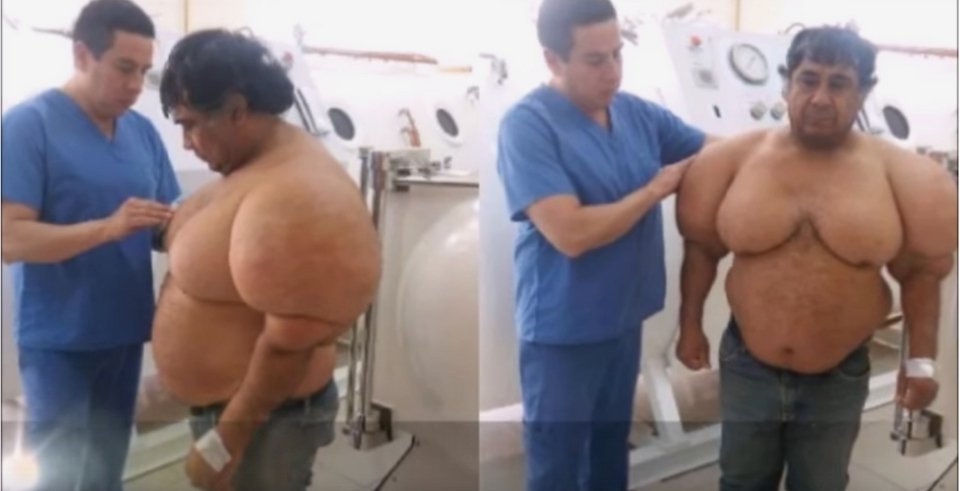 Απίστευτη παραμόρφωση: Ψαράς έπαθε τη νόσο του δύτη και φούσκωσε σαν μπαλόνι [βίντεο] | iefimerida.gr 2