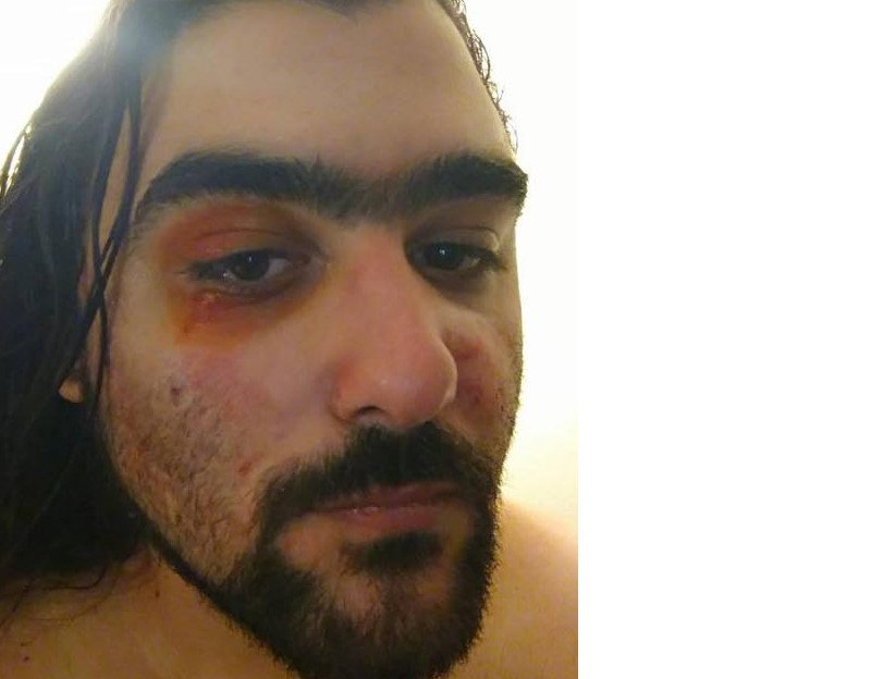 Φοιτητής στη Θεσσαλονίκη: Με χτύπησαν και μου έσκισαν την μπλούζα γιατί έγραφε «Μολών Λαβέ» [εικόνες] | iefimerida.gr 1