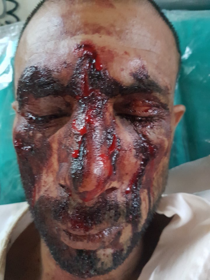 KEEΡΦΑ: Δολοφονική επίθεση χρυσαυγιτών κατά μεταναστών -Τους χτύπησαν με σιδηρογροθιές [σκληρές εικόνες]  | iefimerida.gr 0