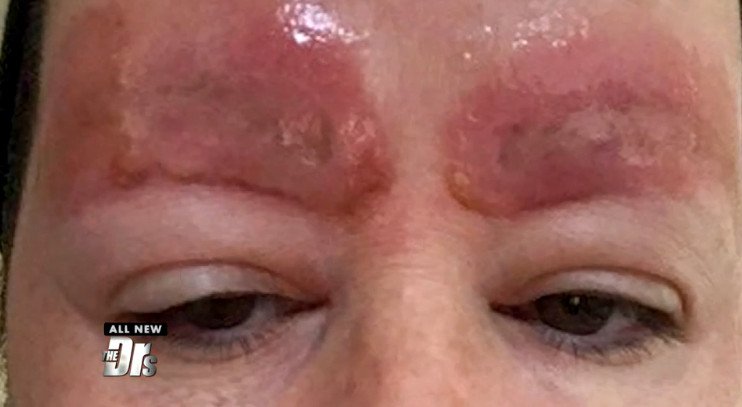 Εικόνες-σοκ: Γυναίκα πήγε να πυκνώσει τα φρύδια και έφυγε με δυο τεράστιες ουλές [εικόνες] | iefimerida.gr 2