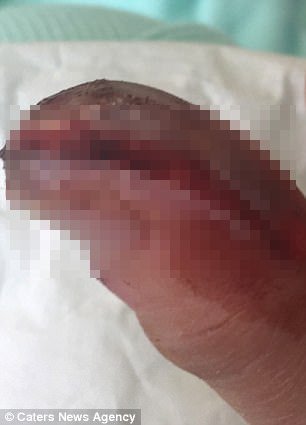 Απίστευτο: Εβγαλε το ακρυλικό νύχι μόνη της, σπίτι της και έπαθε σηψαιμία -Της έκοψαν το δάχτυλο [εικόνες] | iefimerida.gr 2