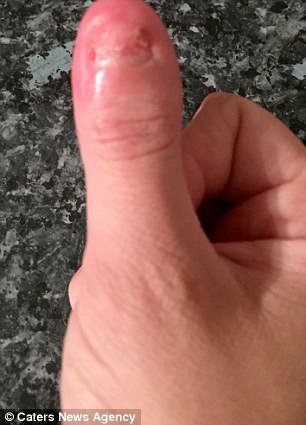 Απίστευτο: Εβγαλε το ακρυλικό νύχι μόνη της, σπίτι της και έπαθε σηψαιμία -Της έκοψαν το δάχτυλο [εικόνες] | iefimerida.gr 1