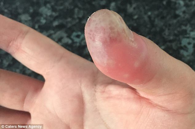 Απίστευτο: Εβγαλε το ακρυλικό νύχι μόνη της, σπίτι της και έπαθε σηψαιμία -Της έκοψαν το δάχτυλο [εικόνες] | iefimerida.gr 4