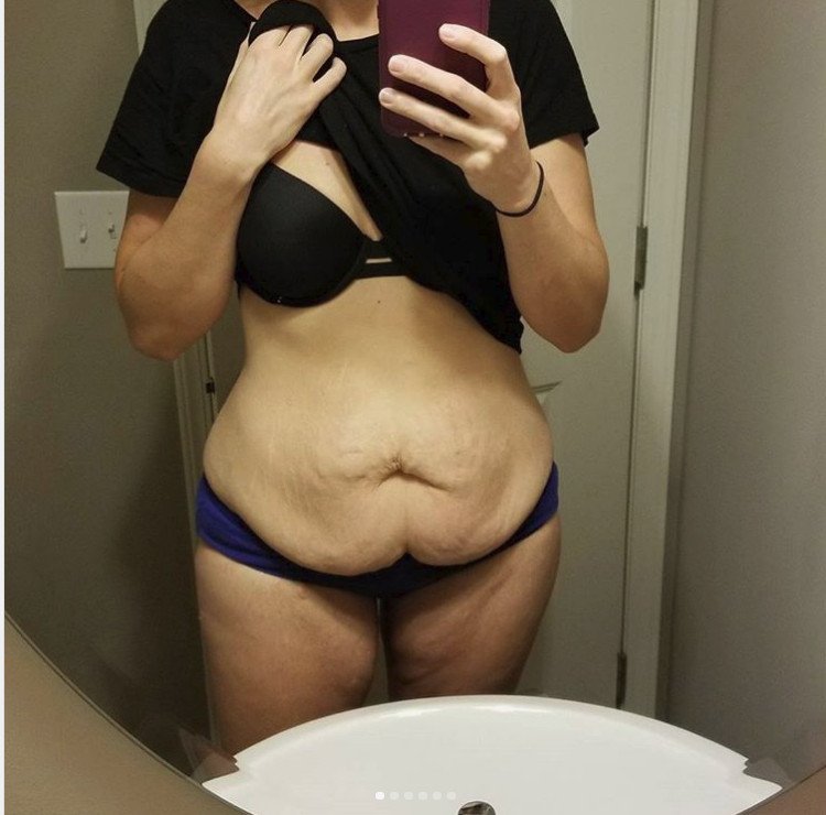 Μια 31χρονη δείχνει τις τομές της από κοιλιοπλαστική και την προσθετική στήθους και σοκάρει [εικόνες] | iefimerida.gr 0