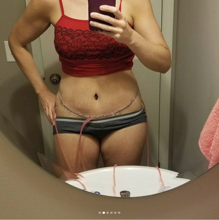 Μια 31χρονη δείχνει τις τομές της από κοιλιοπλαστική και την προσθετική στήθους και σοκάρει [εικόνες] | iefimerida.gr 1