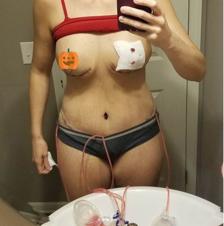 Μια 31χρονη δείχνει τις τομές της από κοιλιοπλαστική και την προσθετική στήθους και σοκάρει [εικόνες] | iefimerida.gr 2