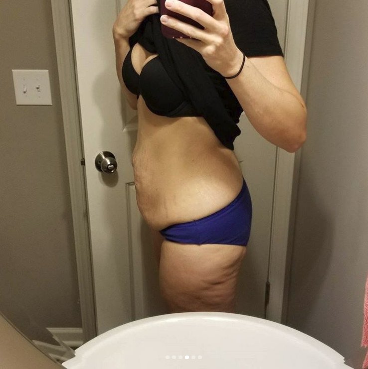 Μια 31χρονη δείχνει τις τομές της από κοιλιοπλαστική και την προσθετική στήθους και σοκάρει [εικόνες] | iefimerida.gr 3