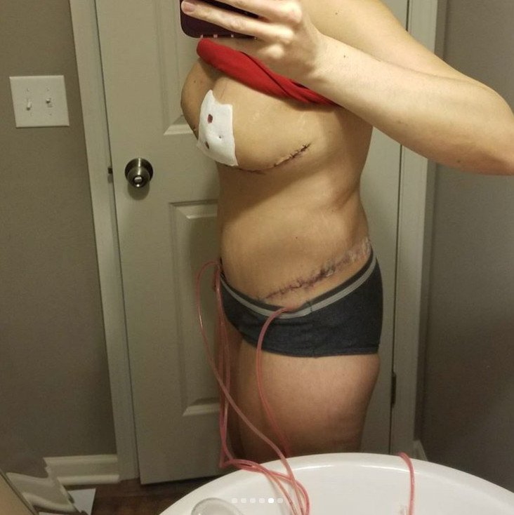 Μια 31χρονη δείχνει τις τομές της από κοιλιοπλαστική και την προσθετική στήθους και σοκάρει [εικόνες] | iefimerida.gr 4