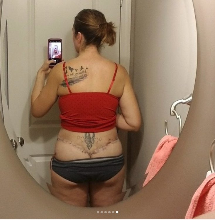 Μια 31χρονη δείχνει τις τομές της από κοιλιοπλαστική και την προσθετική στήθους και σοκάρει [εικόνες] | iefimerida.gr 5