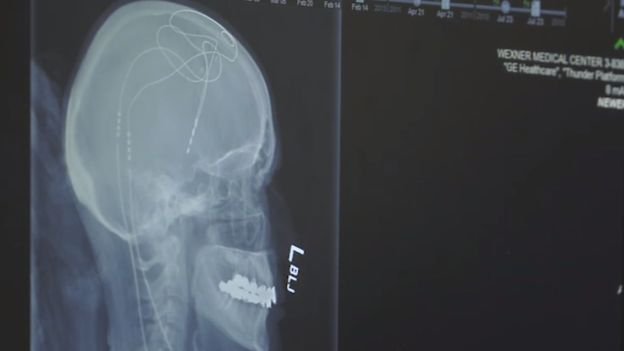 «Βηματοδότη» εγκεφάλου για τη θεραπεία της νόσου Αλτσχάιμερ δοκιμάζουν οι επιστήμονες [εικόνες] | iefimerida.gr 0