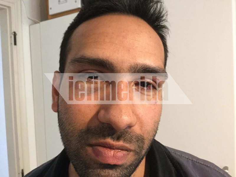  Τρόμος στου Φιλοπάππου -Ομάδα Ρομά επιτέθηκε, ξυλοκόπησε και λήστεψε παρέα [εικόνες] | iefimerida.gr 2