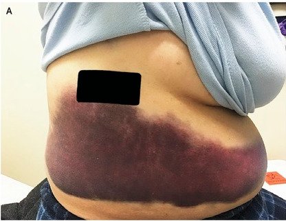 Κι όμως συνέβη: Εβηξε τόσο δυνατά που έσπασε το πλευρό της [εικόνα] | iefimerida.gr 0