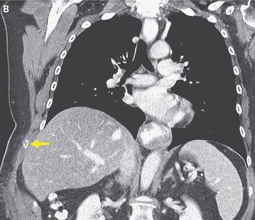 Κι όμως συνέβη: Εβηξε τόσο δυνατά που έσπασε το πλευρό της [εικόνα] | iefimerida.gr 1