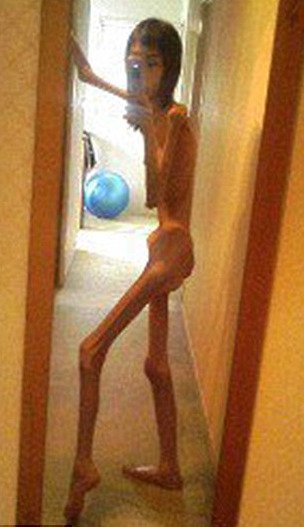 Ανατριχιαστικό: Αυτή η Γιαπωνέζα ζυγίζει μόνο 17 κιλά [εικόνες]  | iefimerida.gr 0